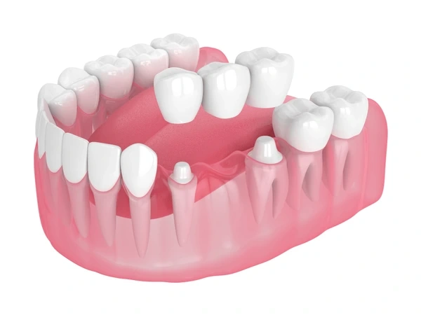 dental bridges near you