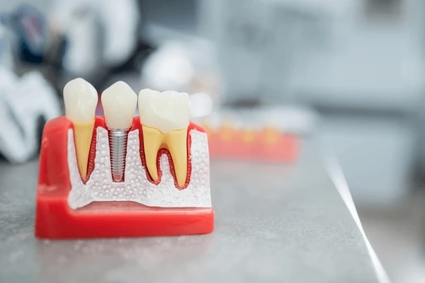 dental implants near you