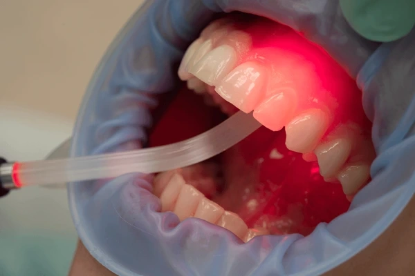 laser gum therapy in mission calgary