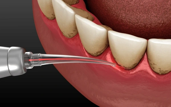 laser gum therapy near you